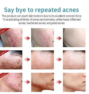 Acne Cream