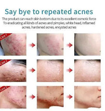 Acne Cream